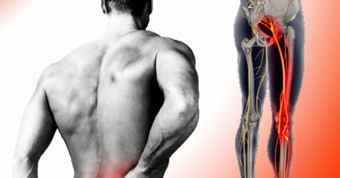 What Is Sciatica And What Can I Do About It In Winnipeg? image