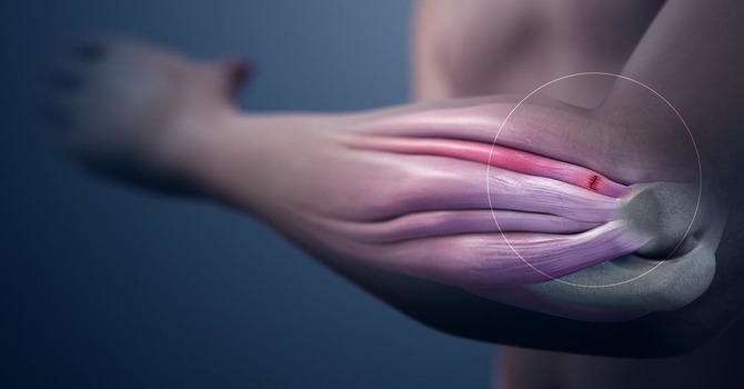 Tendinitis vs Tendinosis 