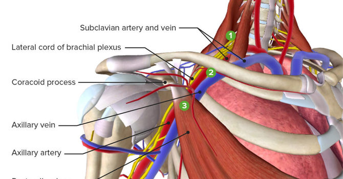 Thoracic Outlet Syndrome (TOS) image